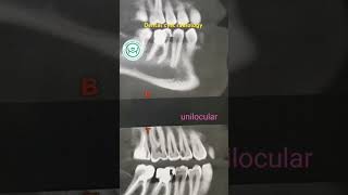 Dental cyst radiology حويصلات الفكين [upl. by Sotnas]