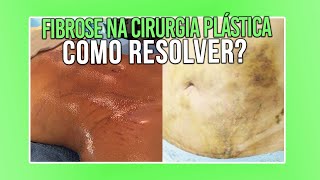 5 COISAS QUE VOCE PRECISA SABER PARA NAO TER FIBROSE NA CIRURGIA PLÁSTICA [upl. by Dnomrej133]