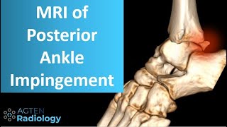 Posterior ankle impingement on MRI [upl. by Yenobe]