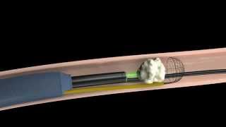 Calculo Renal Tratamiento mediante fragmentacion interna Urologia Peruana [upl. by Stacie167]