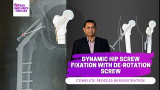 DHS Dynamic Hip Screw For Intertrochanteric Fracture By Dr PS [upl. by Amerigo42]