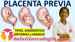 PLACENTA PREVIA CLASIFICACIÓN DIAGNÓSTICO 🩸SÍNTOMAS🩸 MANEJO  Ginecología y Obstetricia [upl. by Marmaduke514]