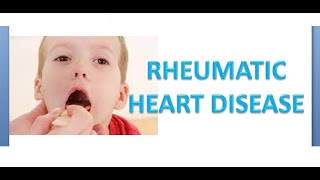 Medicine 146 RHD Rheumatic Fever Heart disease Revised Jones Criteria Chorea Major Minor Pathology [upl. by Sej]