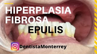 EPULIS HIPERPLASIA Fibrosa👅Causada por Prótesis Dentales [upl. by Motch944]