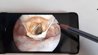 Anatomy of Laryngopharynx HypopharynxENT [upl. by Lenehc7]