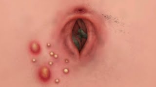 ASMR the best treatment for purulent swollen Acne Bacteria [upl. by Biddy]