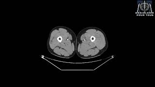 ANGIOSCANNER DE L’AORTE ET DES MEMBRES INFERIEURS Fracture complexe de la jambe [upl. by Spence]