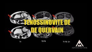 Caso 3  Tenossinovite de De Quervain [upl. by Trow]