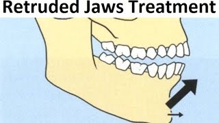 The Orthodontic Treatment of Retruded Backward Jaws Mandible with Tooth Extraction by Dr Mike Mew [upl. by Weeks]