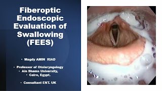 Fiberoptic Endoscopic Evaluation of Swallowing FEES [upl. by Procter292]