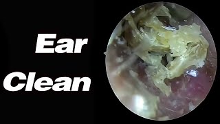 【Ear Picking 】Pus Discharges from The Ears and Earwax Blocks the Ear Canal [upl. by Odnalo495]