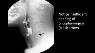 Swallowing disorders  Aspiration due to stasis 2 [upl. by Orravan]