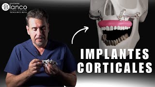 ¡Recupera tu sonrisa con los implantes corticales en 24 horas 😁 [upl. by Pozzy866]