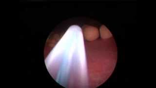 Minimally Invasive Canine Struvite Bladder Stone Removal  Cystoscopy [upl. by Ahsaf438]