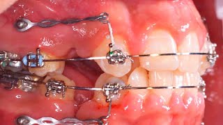 CROWDING TEETH CORRECTION by BRACES [upl. by Ainessej]