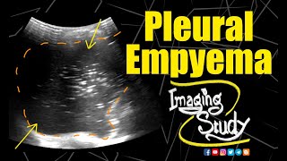 Pleural Empyema  Ultrasound  Case 156 [upl. by Eornom]