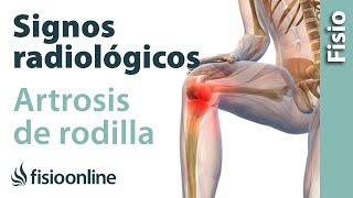 Artrosis de rodilla  Signos radiológicos [upl. by Ultima]