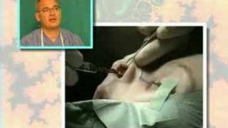 Estetska operacija nosa nose surgery Dr Glusac [upl. by Zobkiw]