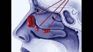 Nasal Polyp Symptoms [upl. by Enahpad]