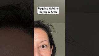 Rogaine Foam Hairline Before And After 💁🏻‍♀️ Minoxidil For Women [upl. by Rubma]