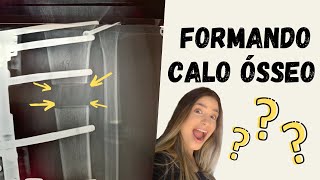 Formação Calo Ósseo  Fixador Externo [upl. by Airalednac]