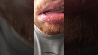 Exfoliative Cheilitis  Dovonex amp Elidel Treatment Results [upl. by Sophie]