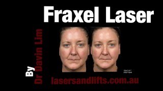 How long does it take to recover from Fraxel laser [upl. by Boelter]