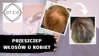 Przeszczep włosów u kobiet  OTCO Clinic [upl. by Dahraf]