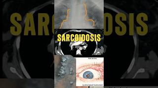 SARCOIDOSIS  CASO CLÍNICO MedicinaMedEdMédicoSaludRadiologíaCasoClínicoEducaciónMédica [upl. by Calendra]