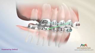 Orthodontic Treatment for Overbite Overjet  Removing Second Molar [upl. by Goldberg]