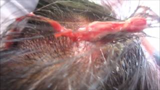 Scalp Abscess [upl. by Viradis]