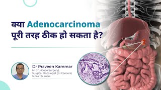 Adenocarcinoma Is a Complete Cure Possible  Cancer QampA  Dr Praveen Kammar Mumbai [upl. by Macfadyn]