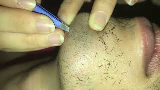 PLUCKING BEARD for mr Nguyễn Lê anh tài ASMR [upl. by Gearhart761]