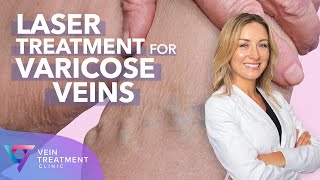 What Are Leg Spider Veins and How are they removed  Causes and Treatment by Microsclerotherapy [upl. by Kcirrad]