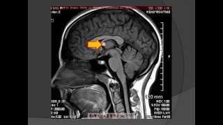 Colloid Cyst Neuroepithelial Cyst [upl. by Mesics]