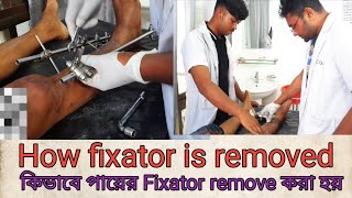 কিভাবে Fixator remove করা হয়How fixator is removedOur Treatment [upl. by Acissej853]