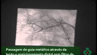 Angioplastia de Artéria Renal [upl. by Aisena]