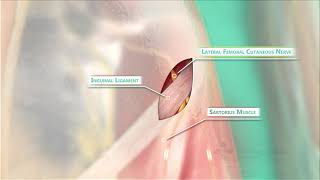 Meralgia Paresthetica Surgery [upl. by Isman]