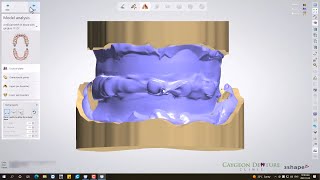 Denture Design with Gnathometer CAD [upl. by Saleem101]