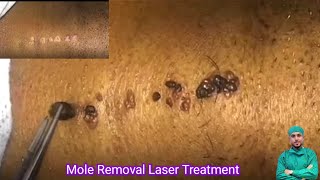 Skin Tags amp Mole Removing By Cautery Machine  Acne Scar amp Mole Permanent Solution  skincare [upl. by Nicolas]