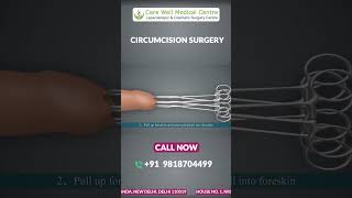 ZSR Circumcision Surgery in Delhi A StepbyStep Animated Guide  Circumcision Surgery Cost shorts [upl. by Garnes]