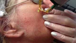 Laser treatment for facial thread veins with Candela NdYag laser [upl. by Shiller]