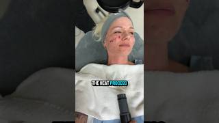 Profractional laser treatment laser antiaging millennial skincare [upl. by Rekyr]