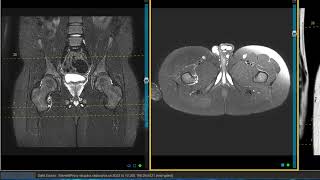 Hip pain in 11 year old after fall at school [upl. by Haisa]