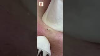 Blackheads Removal  Acne Treatment and Very Satisfying Satisfying Pimple pop blackheads [upl. by Roede]