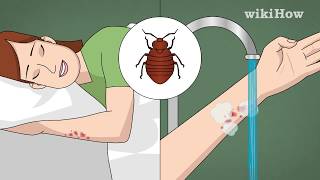 How to Treat Bed Bug Bites [upl. by Dru]