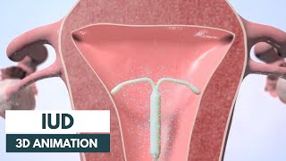 How does an IUD work  3D animation [upl. by Artimid]