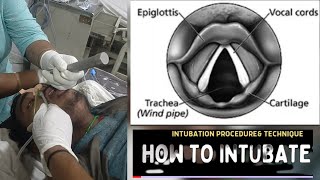 HOW TO INTUBATE INTUBATION PROCEDURE amp TECHNIQUE [upl. by Tnomal]