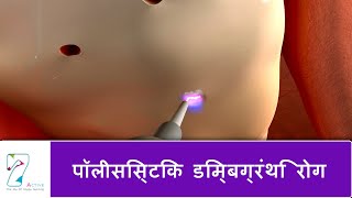 पॉलीसिस्टिक डिम्बग्रंथि रोग  Polycystic Ovarian Disease  Hindi [upl. by Natsirt]