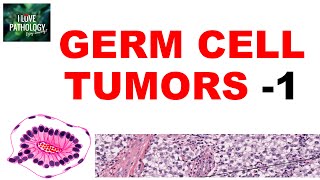 OVARIAN TUMORS  Part 4 Germ cell tumors Dysgerminoma yolk sac tumor  Pathology [upl. by Schmidt]